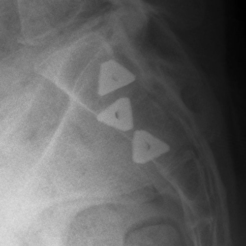 SIJ Fusion Postop Lateral