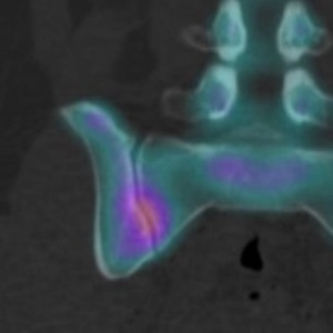 SIJ Fusion Preop SPECT