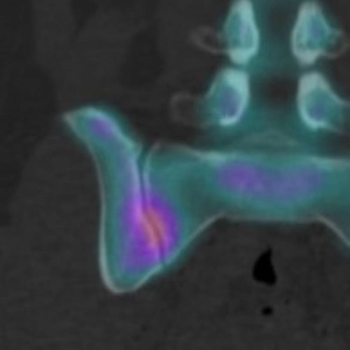 SIJ Fusion Preop SPECT