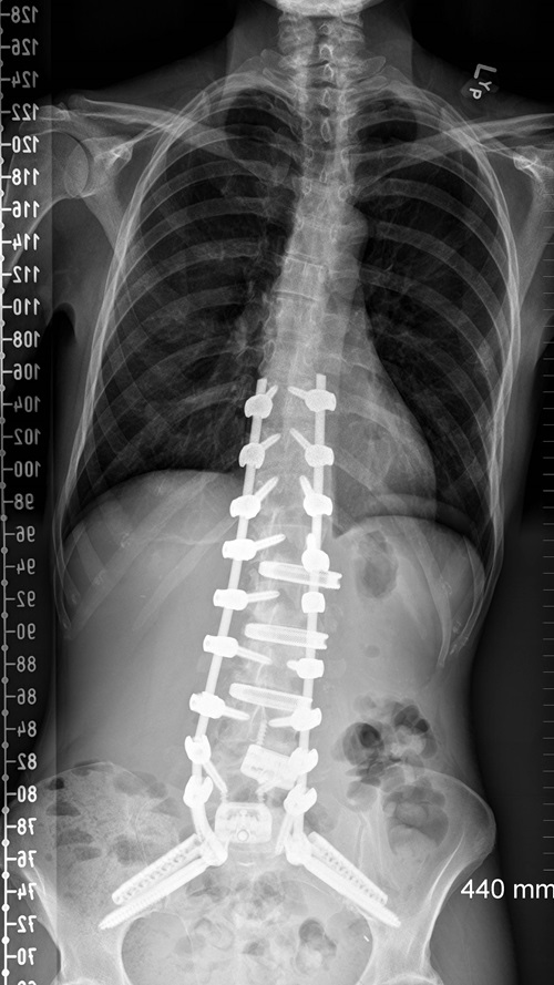 RL AP after Surgery