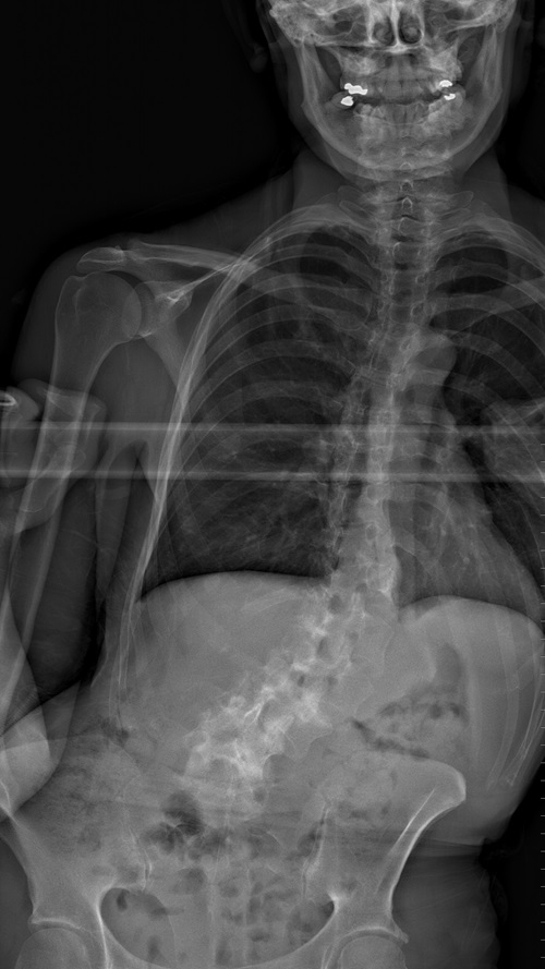 Before Surgery AP