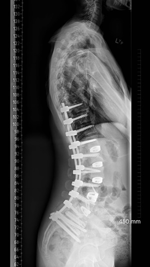 RL Lateral After Surgery 