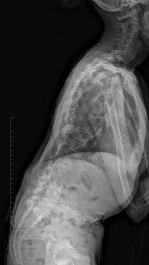 Lateral Before Surgery