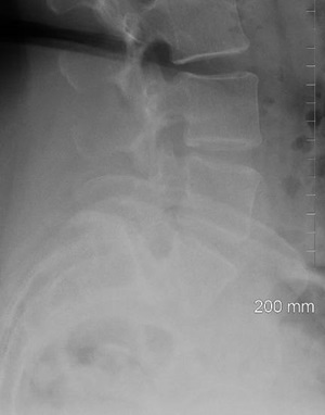 2 Level TLIF before surgery - Robert Lee