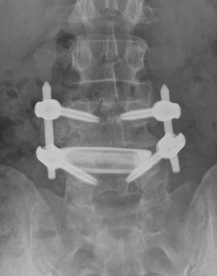 OLIF post op AP - Robert Lee