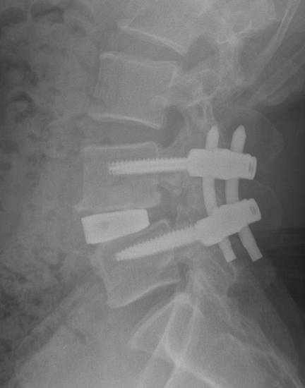 OLIF postop lateral - Robert Lee