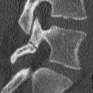 PARS repair before surgery 1