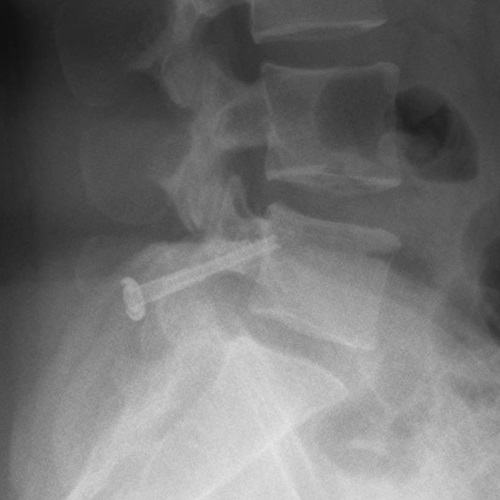 PARS repair lateral 1