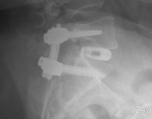 PLIF Lateral - Robert Lee