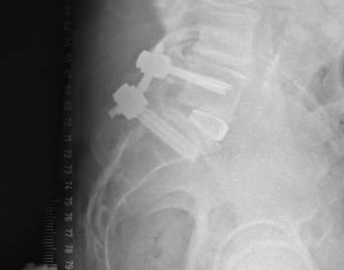 TLIF lateral view - Robert Lee