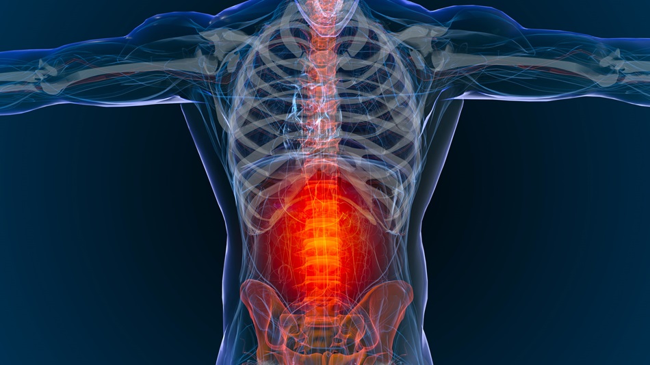 Image depicting a spinal condition